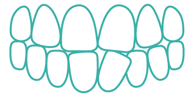 Crooked teeth