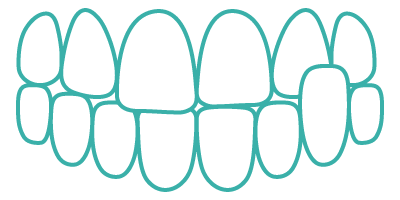 Crossbite