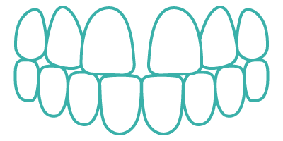 Gapped teeth