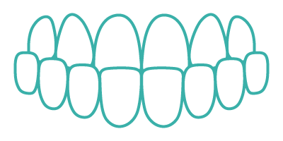 Underbite